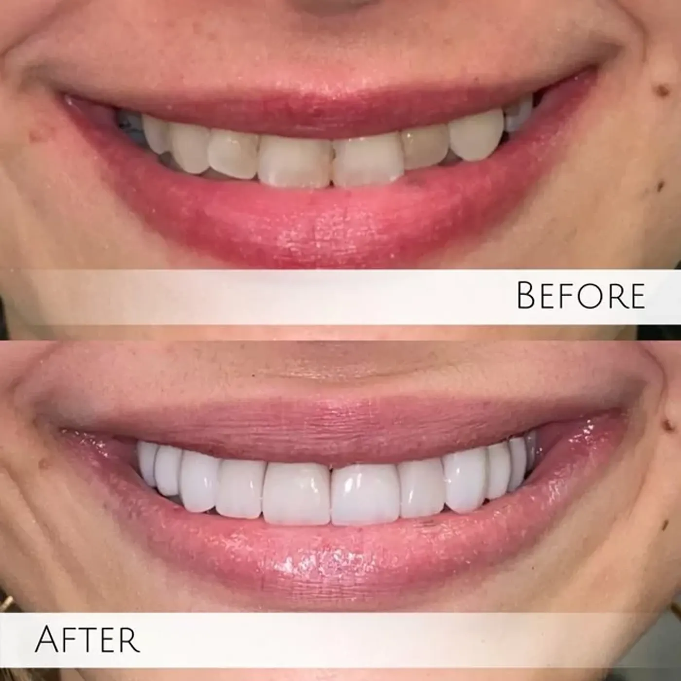 Veneer result shown in the Valley Dental Solutions smile gallery