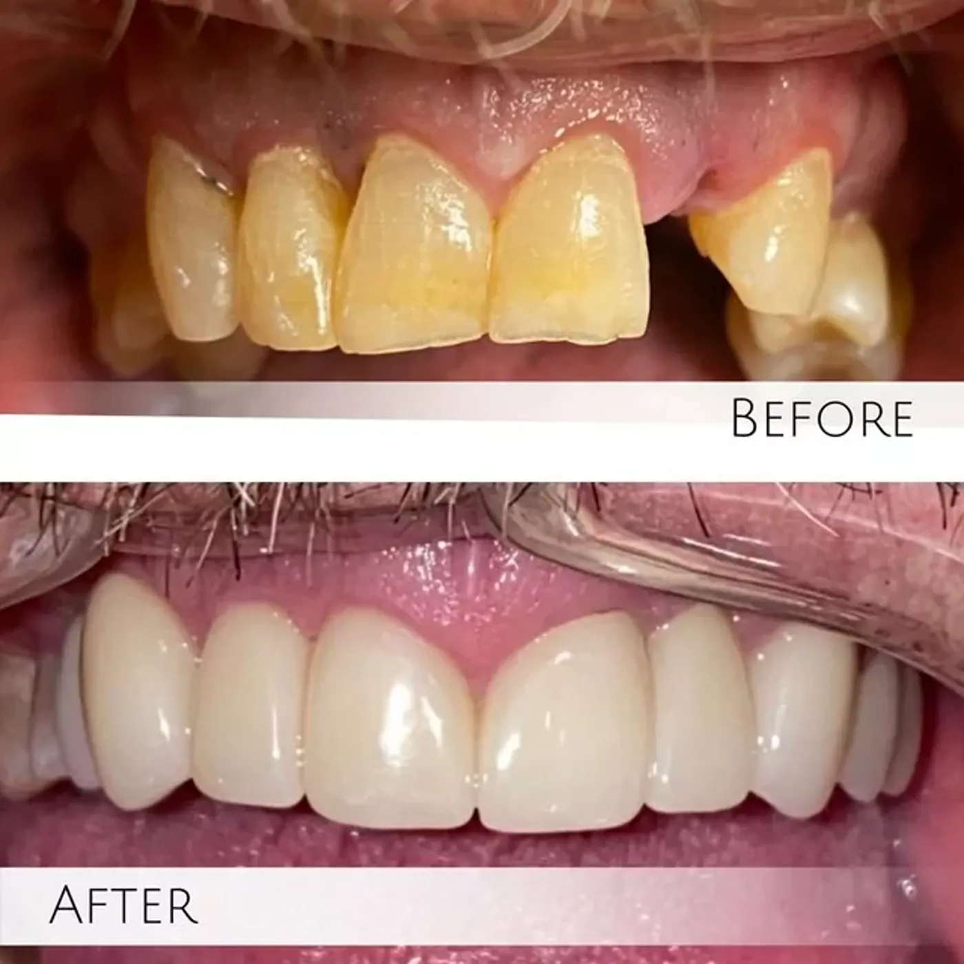 Before and after smile gallery image used by Valley Dental Solutions