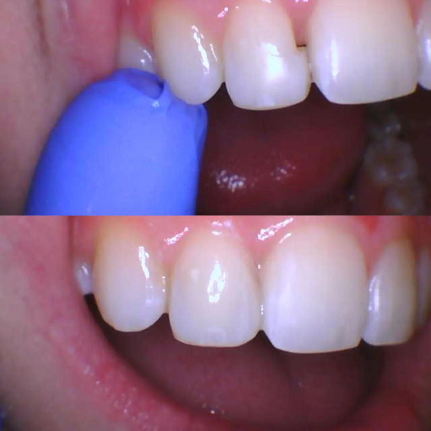 Dental smile result gallery image